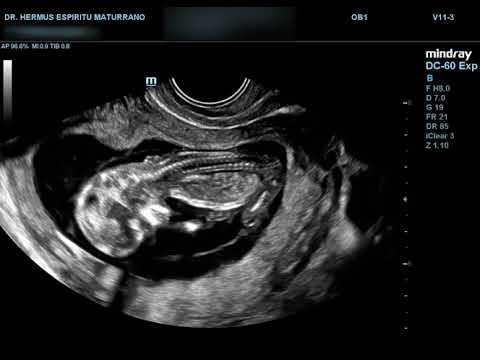Feto de 12 semanas de Gestacion.