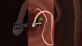 how to prevent hookworm attack? #hookworm #worms