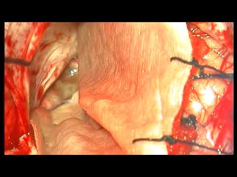Retrosigmoid Approach To Resection Of Cerebellopontine Angle Craniopharyngioma