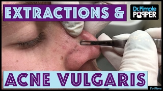 Working Hard for these Blackheads:  Acne Vulgaris & Extractions Session 2