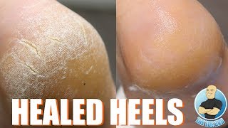 HOW TO TREAT DRY, CRACKED HEELS