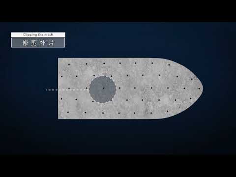 lichtenstein Hernia repair with SIS Absorbable Mesh