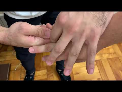 指の脱臼 - 指の脱臼とは何か、治療方法、症状、対処法