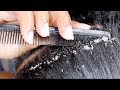 डैंड्रफ को 2 दिनों मे कैसे ख़त्म करे | Natural Way to Remove Dandruff/ Home Remedy | Hindi