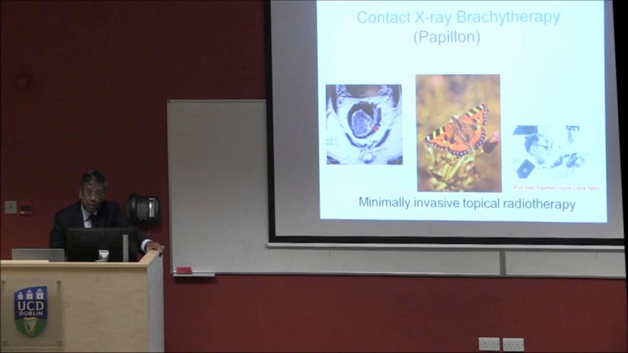 Local Contact Radiotherapy (Papillion) Technique for Rectal Cancer.