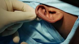 Small hard bump on ear Cartilage - Surgical Removal