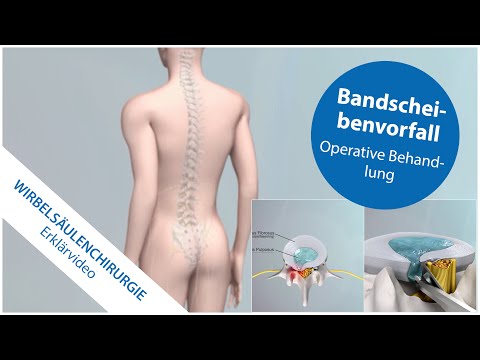 Herniated disc: surgical treatment with the latest technology