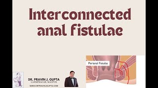 Download Lagu INTERCONNECTED FISTULAE- A SEQUEL OF BURST PERIANAL ABSCESS Thumbnail