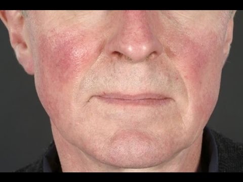 Togliere pigmentary nota il carbonato di sodio Lentiggini e zimushka