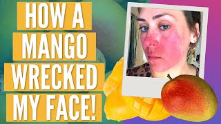 I Thought I Was Allergic to Mango | Mango Mouth | Recovery Progress Pictures