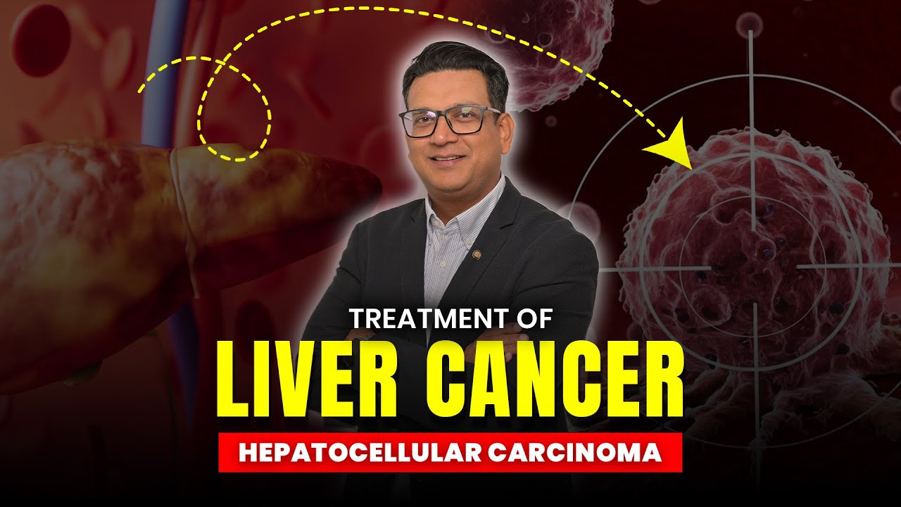 Treatment of Liver Cancer | Hepatocellular Carcinoma Treatment | HCC Liver Cancer #HCC #liver