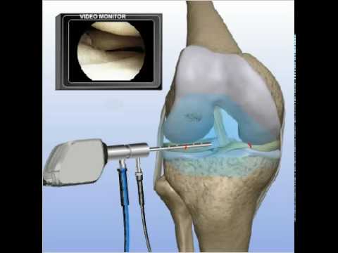 Sintomi fisici della malattia degenerativa del disco cervicale Lombalgia dopo laparoscopia