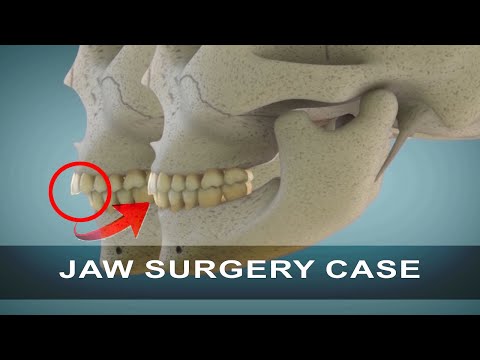 Corrective Jaw Surgery | Orthognathic Surgery | Curveia Dental Animation
