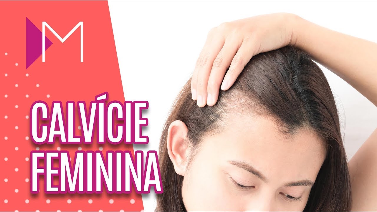 Calvície feminina - Mulheres (13/02/2019)