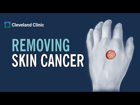 What Is Mohs Surgery?