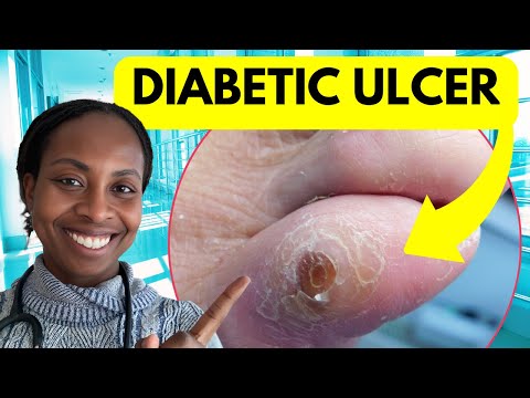 Why Diabetic Foot Ulcers Don’t Heal: Doctor Explains What You’re Missing