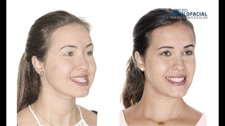 Cirugía ortognática bimaxilar. Mentoplastia. Caso #32: Ylenia - Clase 3