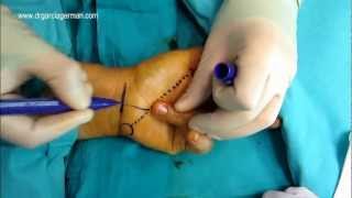 SÍNDROME DEL TÚNEL DEL CARPO  LIBERACIÓN QUIRÚRGICA DEL NERVIO MEDIANO