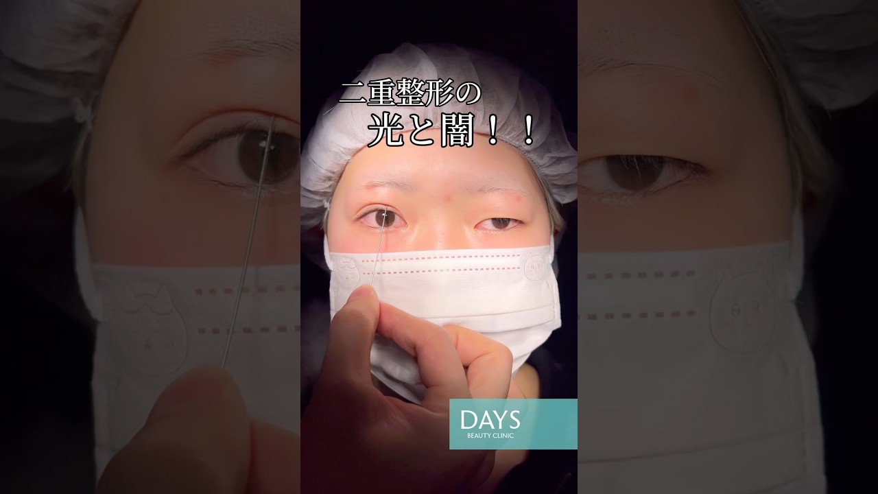 【二重整形】衝撃のビフォーアフター！#shorts