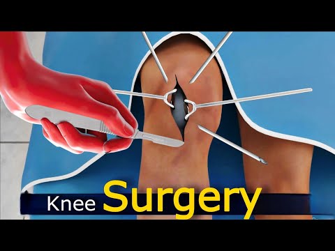 Knee Replacement Surgery : 3D Animation | The Scopic Vision