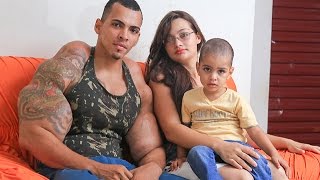 Bodybuilder Addicted To Injecting Arms With Oil & Alcohol