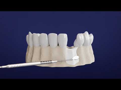 Step by Step Guide to Your Dental Implant Procedure