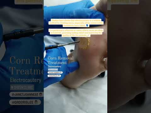 Corn and Callus Removal in Subang Jaya, Malaysia