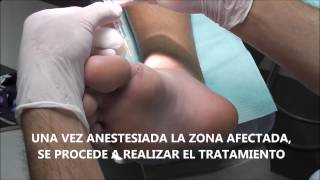 Tratamiento Laser Papilomas - PodoLASER Sevilla