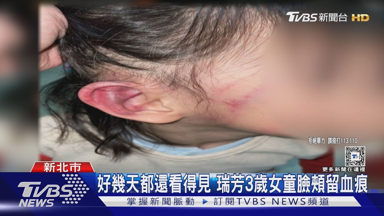 瑞芳3歲女童遭毆！小腿留棍棒狀瘀青、耳朵紅腫 幼園：口罩拉扯所致