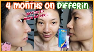 4-MONTH DIFFERIN UPDATE FOR FUNGAL ACNE & BREAKOUTS | Changes, Discovery, Sunscreen, Popping Pimples