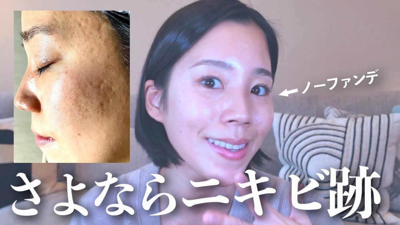 【ニキビ跡治療】大幅に改善した軌跡を全て紹介します