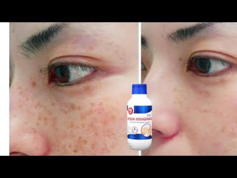 La maschera da un limone per candeggiare di pelle Alla quale età i konopushka appaiono