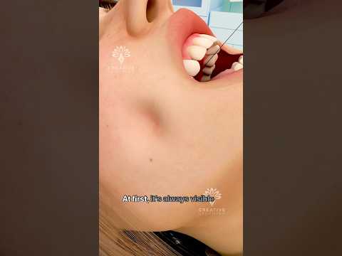 How Dimple Surgery Works 😲#short #dimpleplasty - Creativelearning3d
