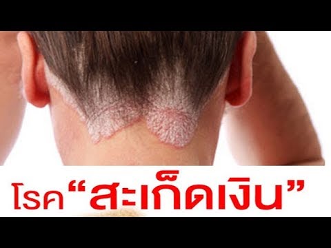 โรคสะเก็ดเงินบนข้อพับข้อศอก ครีมกลากบนผิวของมือ