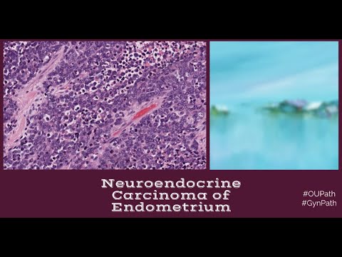 Neuroendocrine Carcinoma of Endometrium