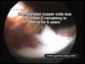 Hysteroscopic removal of impacted IUCD (Copper T ...