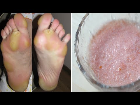 Mâncărime între tratamentul degetelor de la picioare