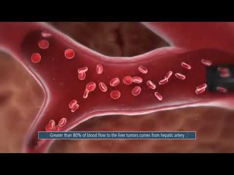 Thera Sphere  Advanced 3D Technology Tumor Treatment - Mechanism of Action Drug Delivery Microsphere