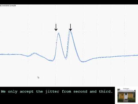 SFEMG - Technique EDC  (Erik Stalberg)