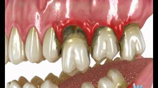 Implantes dentales. DeltaDent, clinica dental en Madrid - Clínica Dental Delta Dent
