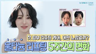 울타늄 리프팅 시술, 시술 전후가 궁금하다면? - 생생한 후기로 공유하는 울타늄 5주간의 변화 대 공개 !