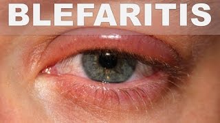 ☞ Remedios caseros para la blefaritis – Como aliviar la inflamación de los parpados