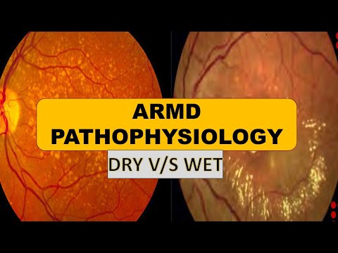Age- related macular degeneration (AMD) | Pathogenesis of dry AMD and Wet AMD, drusens ,CNVM..