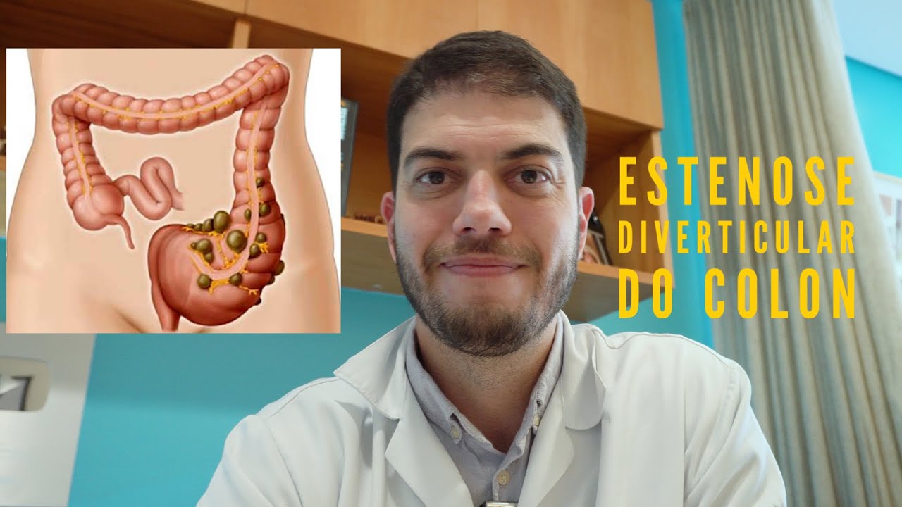 Estenose diverticular do cólon - o que é? Como é o tratamento?