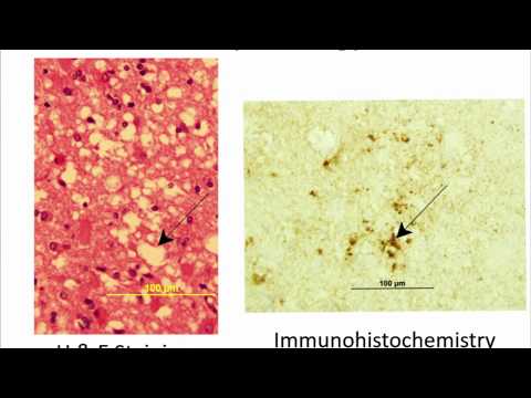 Prion Disease/CJD (Creutzfeld-Jakob Disease) Basics - Brian Appleby