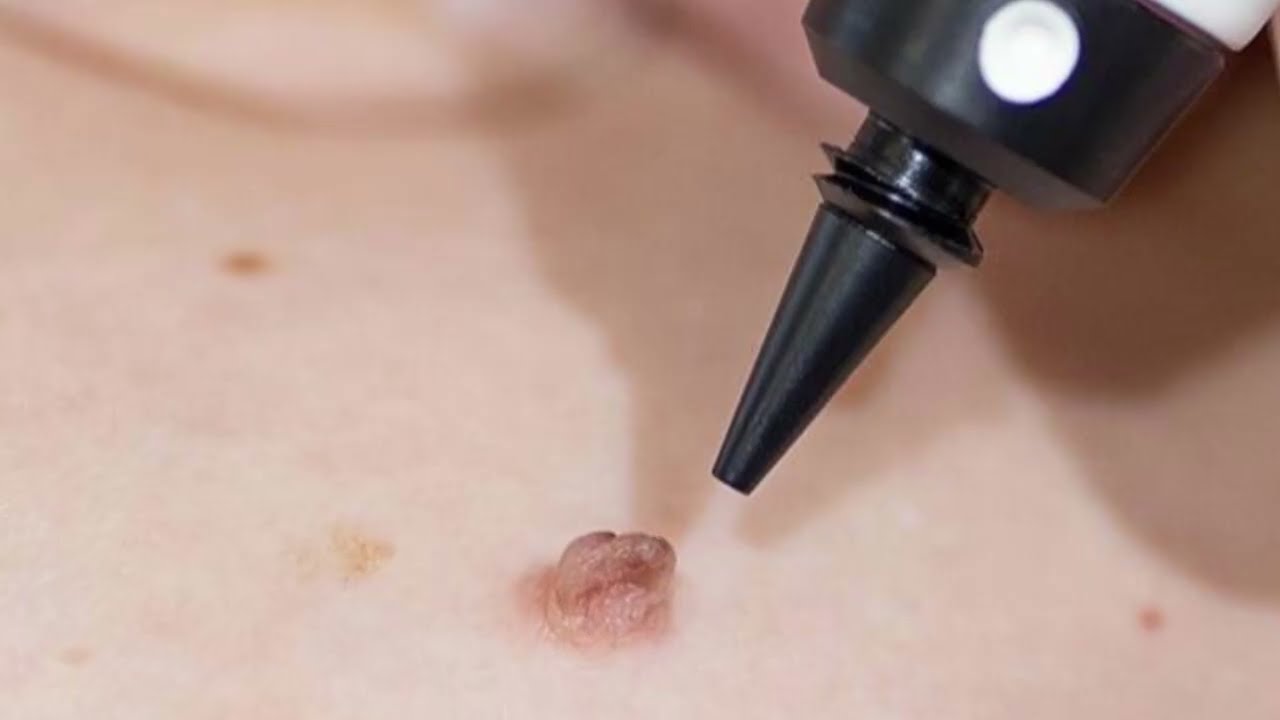 ΚΡΥΟΠΗΞΊΑ - Cryosurgery