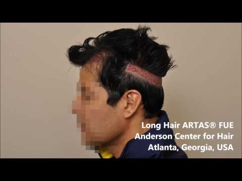 Long Hair FUE using the ARTAS Robotic Hair Transplant System
