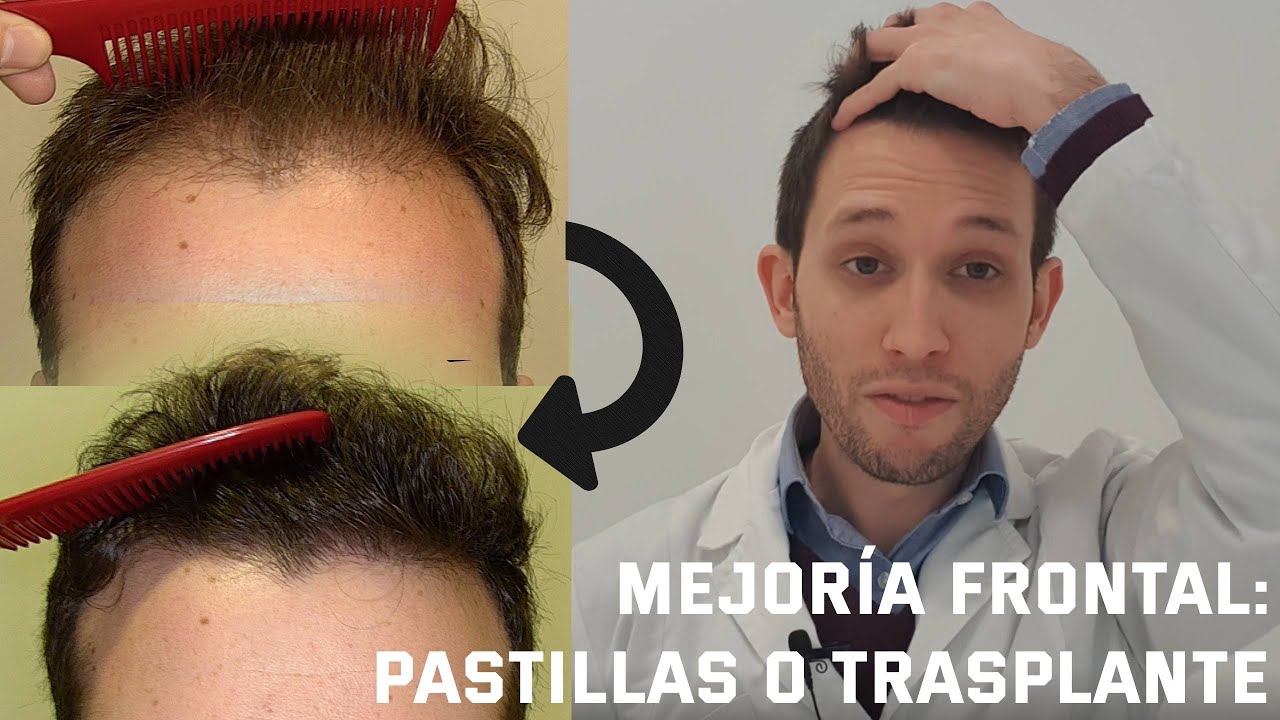 Watch DERMATÓLOGO explica cómo mejorar la ALOPECIA ANDROGÉNICA FRONTAL Now DERMATÓLOGO explica cómo mejorar la ALOPECIA ANDROGÉNICA FRONTAL