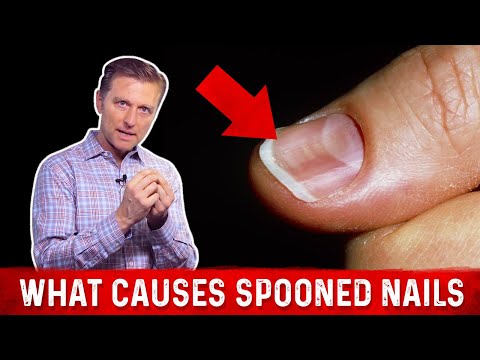Paggamot ng toe kuko halamang-singaw laser Kung paano sa paggamot sa kuko halamang-singaw sa aking mga paa na agad