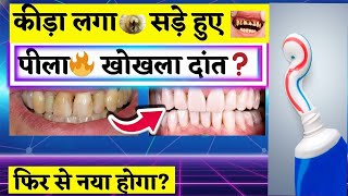 ब्रश करो या मत करो साल में 1 बार इससे धो लो दाँत साफ़ हो जायेग Best Toothpaste For All Teeth Problems
